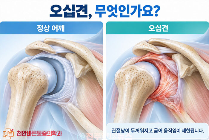 오십견 증상, 팔이 안 올라간다면 꼭 확인해야 할 5가지…회전근개 질환과 차이는?
